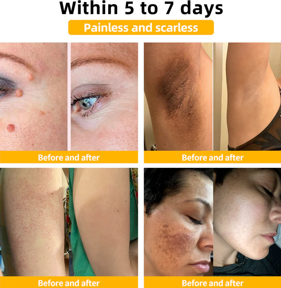 BEE VENOM Skin Restoration Cream – 🌸 Anti-aging, Hydrating, Skin Repair, Even Tone, Acne and Dark Spot Treatment, Wart and Mole Removal, Psoriasis Relief