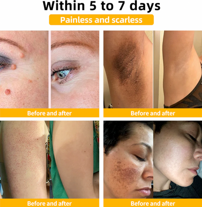 BEE VENOM Skin Restoration Cream – 🌸 Anti-aging, Hydrating, Skin Repair, Even Tone, Acne and Dark Spot Treatment, Wart and Mole Removal, Psoriasis Relief