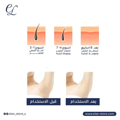 At-Home IPL Hair Removal Handset: Permanent, Painless, & Professional Smooth Skin